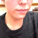 ボトックス（口角） 新未来クリニック BEFORE サムネイル用