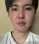 その他（肌） / ハイフ（顔） TCB東京中央美容外科 周南徳山駅ビル院 BEFORE サムネイル用