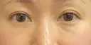クマ治療 / 下まぶたたるみ取り 湘南美容クリニック 千葉センシティ院 BEFORE サムネイル用