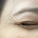 ボトックス（目尻） PRO CLINIC プロクリニック 銀座院 BEFORE サムネイル用