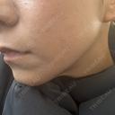ピコレーザートーニング（美白・肝斑） サクラアズクリニック 大阪心斎橋院 BEFORE サムネイル用