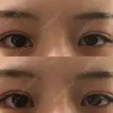 ボトックス（タレ目） 新宿ラクル美容外科クリニック 新宿院 BEFORE サムネイル用