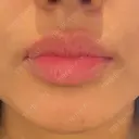 ヒアルロン酸注入（唇） 麻布十番クレールデンタルクリニック BEFORE サムネイル用