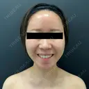 糸リフト / 脂肪吸引（顔） / メーラーファット除去 BLINC CLINIC （ブリンク クリニック） BEFORE サムネイル用