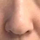 鼻尖形成（切開） / 軟骨移植 / 鼻孔縁下降 / 鼻柱下降・鼻唇角形成（猫手術） もとび美容外科クリニック 新宿院 BEFORE サムネイル用