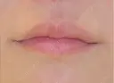 口角挙上 LOUIS CLINIC 二子玉川院【ルイクリニック】 BEFORE サムネイル用