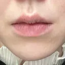 ヒアルロン酸注入（唇） シンデレラ＆ダヴィンチクリニック BEFORE サムネイル用