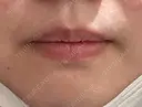 ボトックス（口角） 椿クリニック 心斎橋院 BEFORE サムネイル用