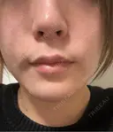 糸リフト / 脂肪吸引（顔） Wing clinic 豊中駅前院 BEFORE サムネイル用