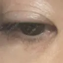 その他（目元） ネビュラクリニック 広島院 BEFORE サムネイル用