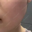 ボトックス（エラ・小顔） / ボトックス（肩） おおたかの森ビューティークリニック BEFORE サムネイル用