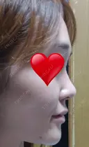 二重切開 / 目頭切開 / 眼瞼下垂（切開） / 隆鼻術 / 目尻切開 / 上まぶたたるみ取り / 軟骨移植 湘南美容クリニック 岡山院 BEFORE サムネイル用