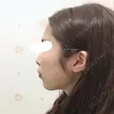 脂肪注入（輪郭） / 再生医療 / PRP皮膚再生療法 チョンダムオラクル皮膚科整形外科医院 BEFORE サムネイル用