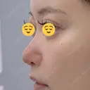 隆鼻術 / 鼻尖形成（切開） / 鼻中隔延長（切開） / 軟骨移植 / 鼻修正 / 鼻尖縮小 / 真皮移植 / 小鼻縮小（非切開） 銀座マイアミ美容外科 BEFORE サムネイル用