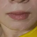 ボトックス（あご） ルラ美容クリニック 新宿院 BEFORE サムネイル用