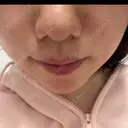 ダーマペン 心斎橋KT美容クリニック BEFORE サムネイル用
