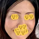 ボトックス（エラ・小顔） TCB東京中央美容外科 梅田茶屋町院 BEFORE サムネイル用