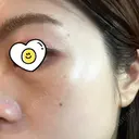 クマ治療 / 豊胸（脂肪注入） / 脂肪注入（目の下） R Beauty CLINIC 銀座院 BEFORE サムネイル用