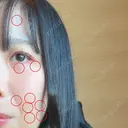 ほくろ・いぼ切除（肌） KARIS beauty clinic BEFORE サムネイル用