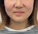 ピーリング（ニキビ・毛穴） / ルメッカ ルラ美容クリニック 横浜院 BEFORE サムネイル用
