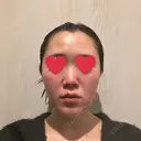 隆鼻術 / 鼻尖形成（切開） / 鼻中隔延長（切開） / 軟骨移植 / 斜鼻修正 / 鼻孔縁挙上 / 鼻翼基部形成（貴族手術） / 鼻柱下降・鼻唇角形成（猫手術） 4Dクリニック BEFORE サムネイル用