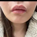 ボトックス（あご） / ボトックス（エラ・小顔） / ヒアルロン酸注入（唇） / ボトックス（眉間） / ボトックス（人中） 上野美容外科・美容皮膚科 BEFORE サムネイル用