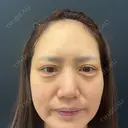 クマ治療 湘南美容クリニック 西葛西院 BEFORE サムネイル用