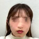 脂肪吸引（顔） TCB東京中央美容外科 新横浜院 BEFORE サムネイル用