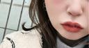 ヒアルロン酸注入（あご） / ルメッカ Code Beauty Clinic 名古屋院 BEFORE サムネイル用