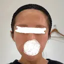 脂肪注入（額） EMMA CLINIC（エマクリニック） BEFORE サムネイル用