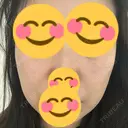 リジュラン ミニマムスキンクリニック池袋 BEFORE サムネイル用