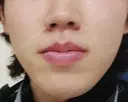 医療脱毛（顔） メンズスキンクリニック 銀座院 BEFORE サムネイル用