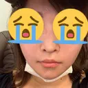 隆鼻術 / 鼻尖形成（切開） / 鼻孔縁挙上 / 鼻尖縮小 加美（GAMI）整形外科 BEFORE サムネイル用