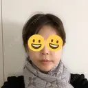 人中短縮 / 鼻翼挙上 大阪TAクリニック BEFORE サムネイル用