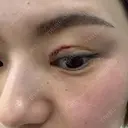目頭切開 / その他（目元） Leap beauty clinic BEFORE サムネイル用