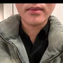 ボトックス（エラ・小顔） BiBiクリニック BEFORE サムネイル用