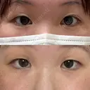 二重切開 / 眼瞼下垂（切開） / 上まぶたたるみ取り ユア美容クリニック 福岡院 BEFORE サムネイル用