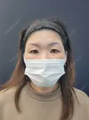二重埋没 湘南美容クリニック 千葉センシティ院 BEFORE サムネイル用