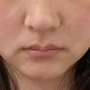 RF（高周波）たるみ治療 あいちビューティークリニック BEFORE サムネイル用