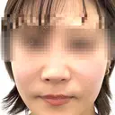鼻中隔延長（非切開） YBC横浜美容外科 池袋院 BEFORE サムネイル用