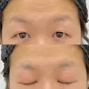 二重切開 / 上まぶたたるみ取り / 上まぶたの脂肪取り VIDA BEAUTY CLINIC BEFORE サムネイル用