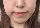 脂肪吸引注射（顔） 東京シンデレラ美容外科 池袋院 BEFORE サムネイル用