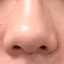 鼻尖形成（切開） / 小鼻縮小（切開） / 眉間プロテーゼ 東京シンデレラ美容外科 池袋院 BEFORE サムネイル用