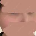 ヒアルロン酸注入（涙袋） / ヒアルロン酸注入（唇） PRO CLINIC プロクリニック 銀座院 BEFORE サムネイル用