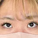 二重埋没 / 目頭切開 アリエル美容クリニック 大宮院 BEFORE サムネイル用