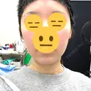 脂肪吸引注射（顔） ルラ美容クリニック 名古屋栄院 / ルラスキンクリニック 名古屋栄院 BEFORE サムネイル用