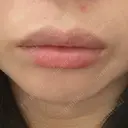 口角挙上 / その他（口元） アネシス美容クリニック BEFORE サムネイル用