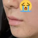 ヒアルロン酸注入（唇） / ボトックス（口角） ルラ美容クリニック 高田馬場院 BEFORE サムネイル用