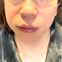隆鼻術 / 鼻中隔延長（切開） / その他（鼻） / 軟骨移植 / ワシ鼻修正・ハンプ切除 / 鼻尖縮小 / 鼻翼基部形成（貴族手術） 4Dクリニック BEFORE サムネイル用