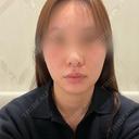 糸リフト / ヒアルロン酸注入（鼻） / ヒアルロン酸注入（あご） 銀座みゆき通り美容外科 大阪梅田院 BEFORE サムネイル用